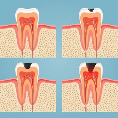 Como-usar-el-aceite-de-coco-para-las-caries